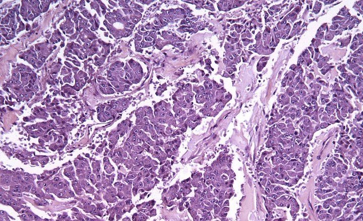 Micrograph&#x20;of&#x20;a&#x20;acinar&#x20;cell&#x20;carcinoma&#x20;of&#x20;the&#x20;pancreas