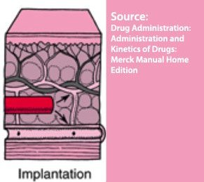 Implantation