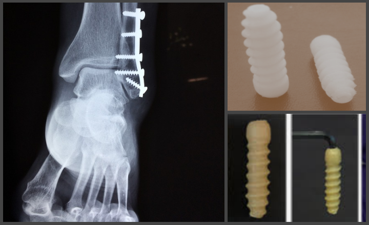 Screw visual observation showed the fractured screws (upper), some