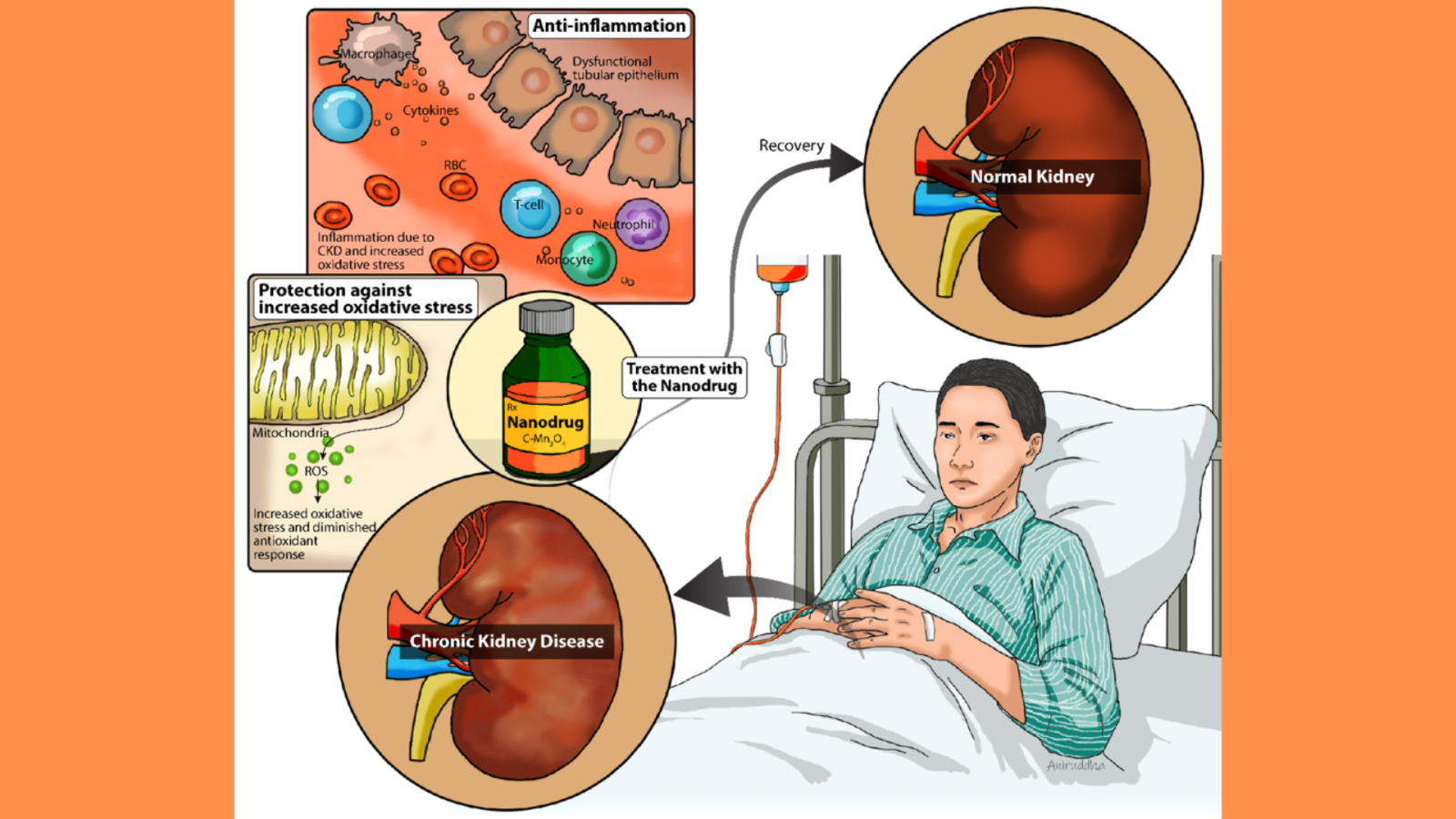 An&#x20;illustration&#x20;explaining&#x20;the&#x20;potential&#x20;of&#x20;nanodrugs&#x20;in&#x20;the&#x20;treatment&#x20;of&#x20;chronic&#x20;kidney&#x20;disease.