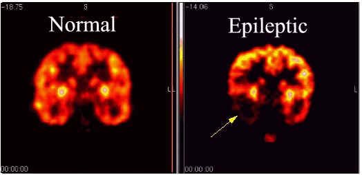 Scans&#x20;showing&#x20;the&#x20;difference&#x20;between&#x20;a&#x20;normal&#x20;and&#x20;epileptic&#x20;brain