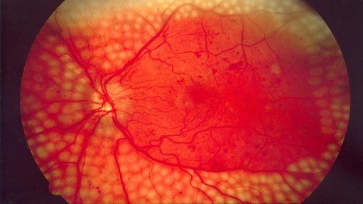 Fundus&#x20;photo&#x20;showing&#x20;scatter&#x20;laser&#x20;surgery&#x20;for&#x20;diabetic&#x20;retinopathy&#x20;