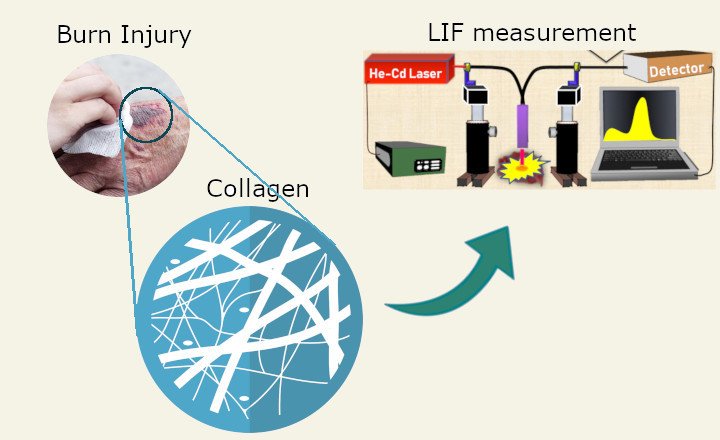 “Optical Biopsies” may help burn victims