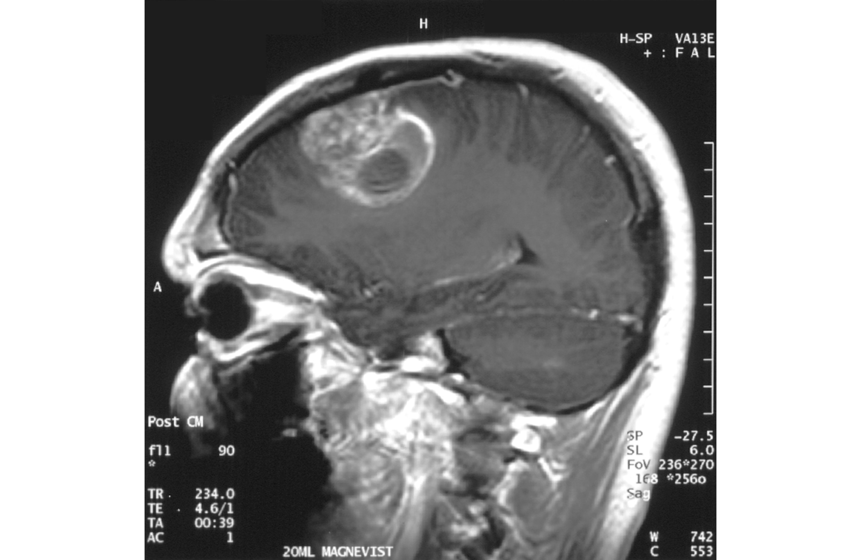 MRI image showing the presence of glioblastoma