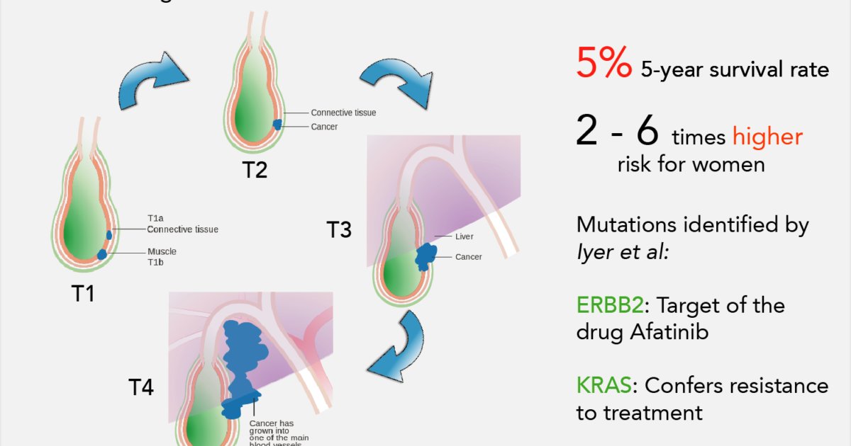 Towards personalized therapy for Indian gallbladder cancer patients