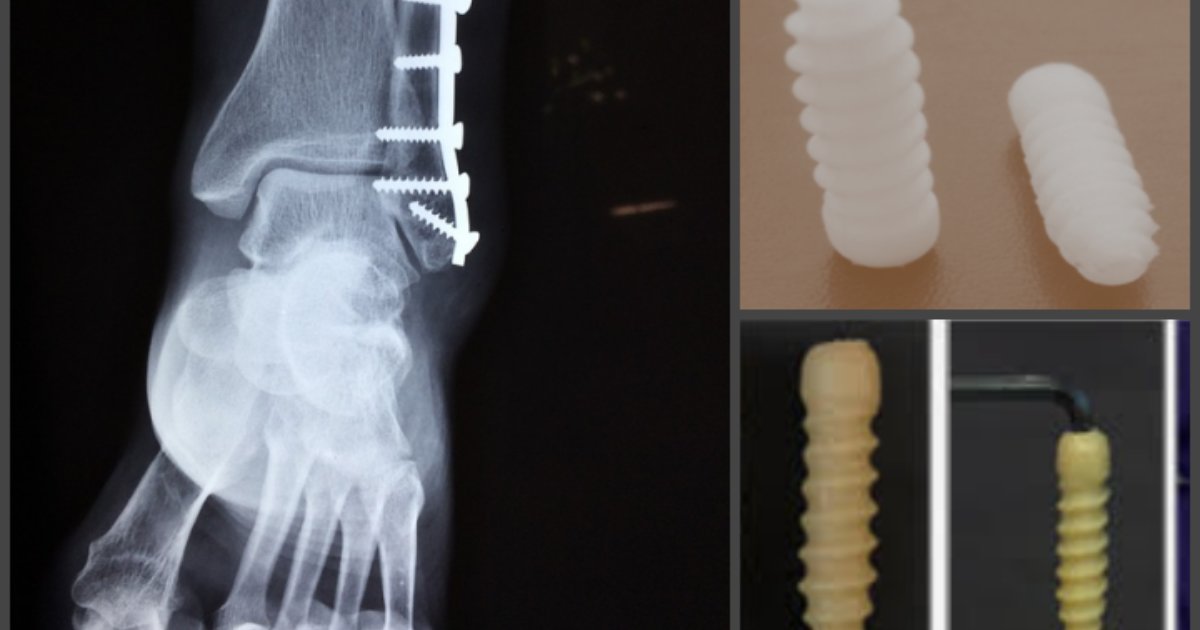 Make In India Biodegradable Screws For Fixing Bone Injuries Indiabioscience