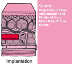 Implantation